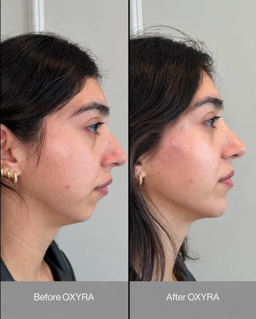 OXYRA MOUTH TAPE PRO.